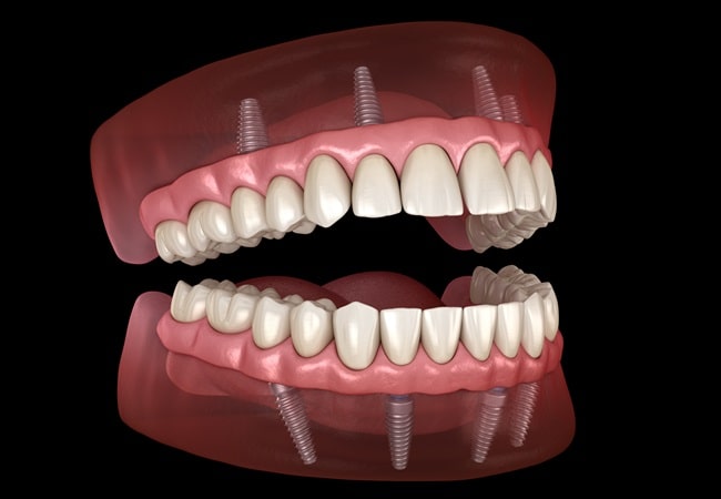 all-on-4-dental-implants-dr-dove-dental-office