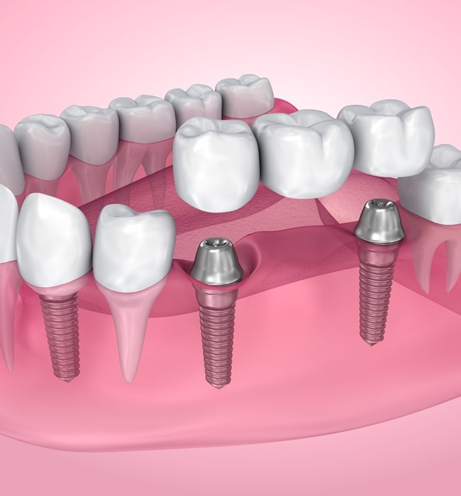all-on-4-dental-implants-in-dr-dove-dental-office