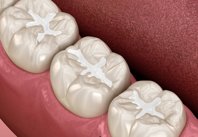 composite-dental-fillings-dr-dove-dental-office