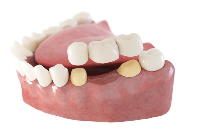 dental-bridges-dr-dove-dental-office