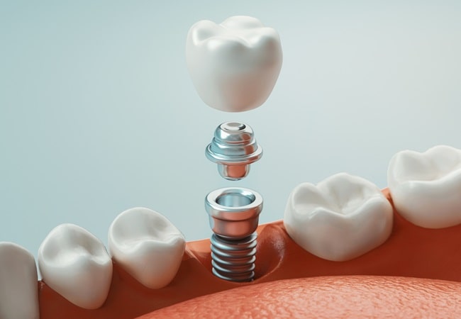dental-implants-dr-dove-dental-office