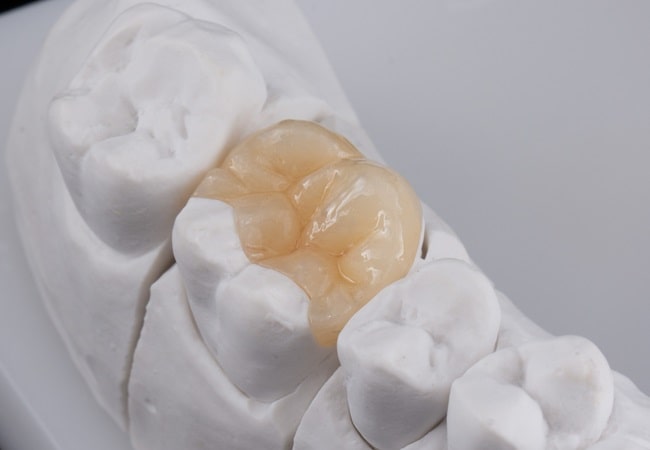 inlays-and-onlays-dr-dove-dental-office